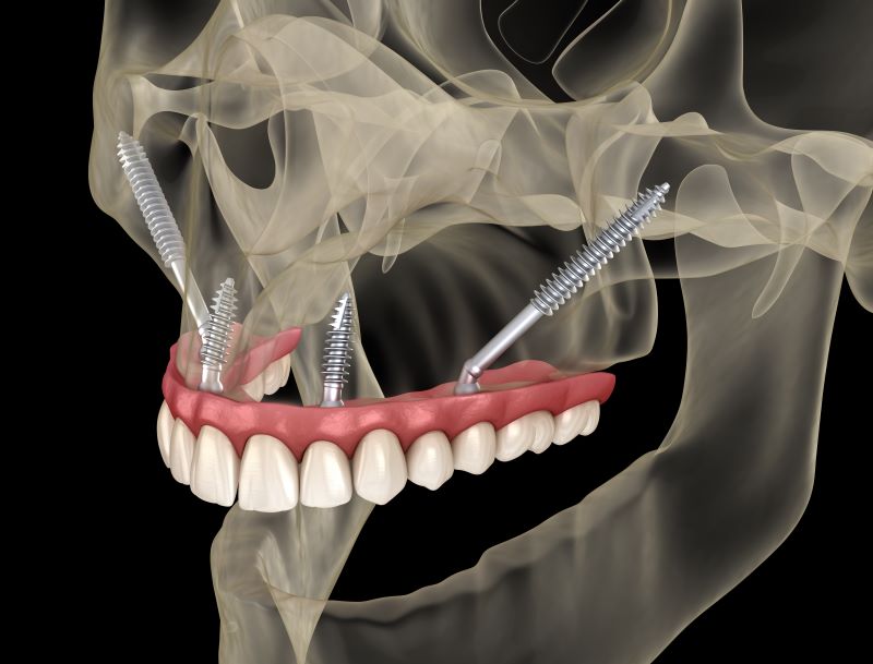 Zygomatic implants
