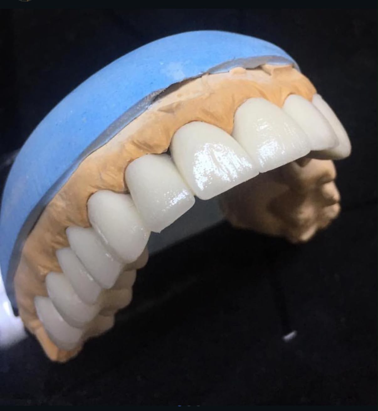 Monolithic Zirconium Crowns