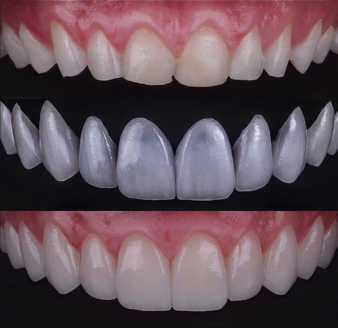 E-Max Crowns